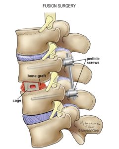 林俊傑病變？！微創內視鏡手術，解決「鄰近節病變」的新選擇！