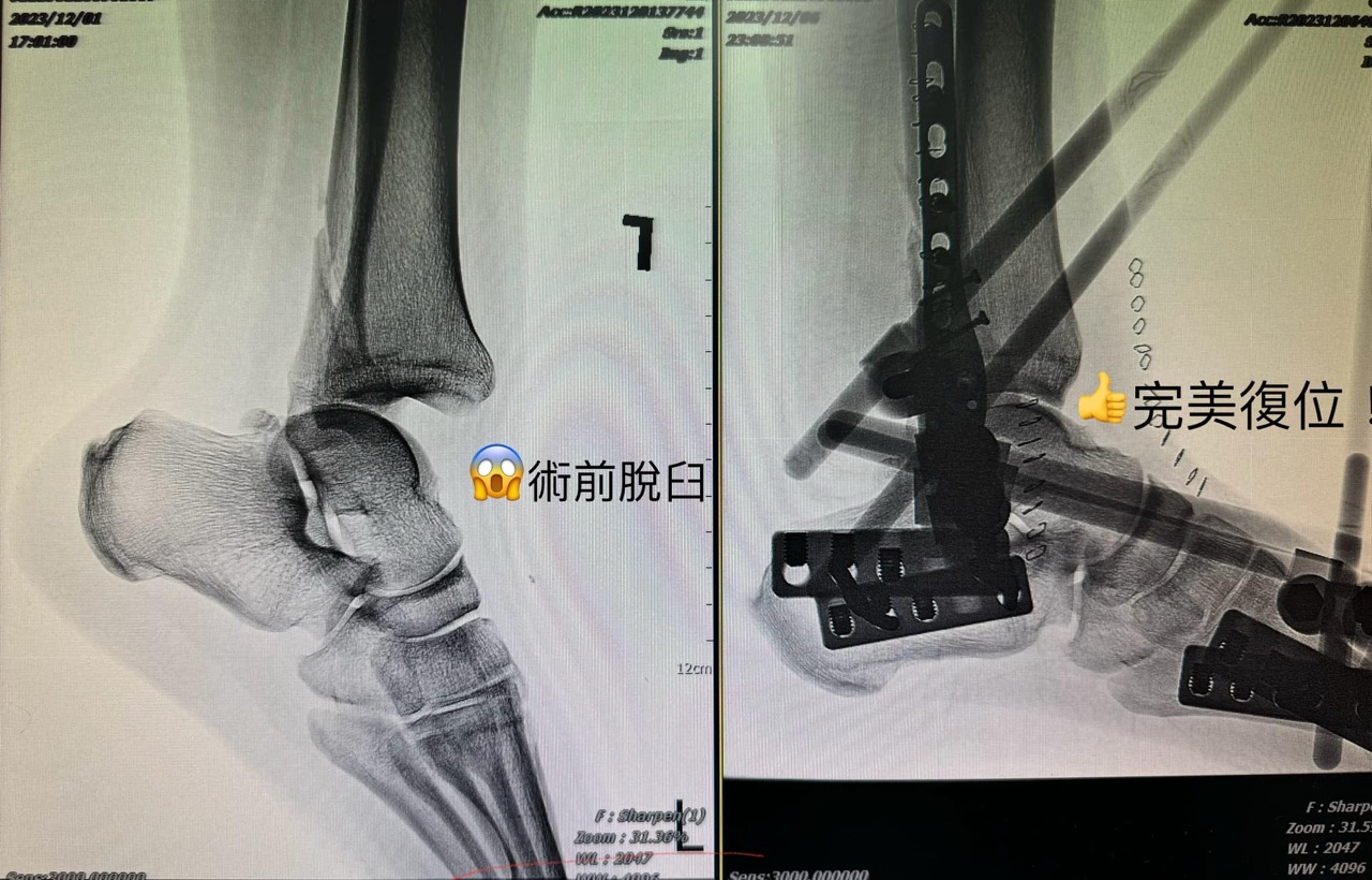 追求99.9%完美！骨科醫師的執念，一台腳踝骨折手術改變患者一生的關鍵
